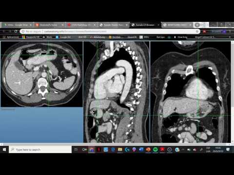 TAC de abdomen! Reconociendo estructuras (1)