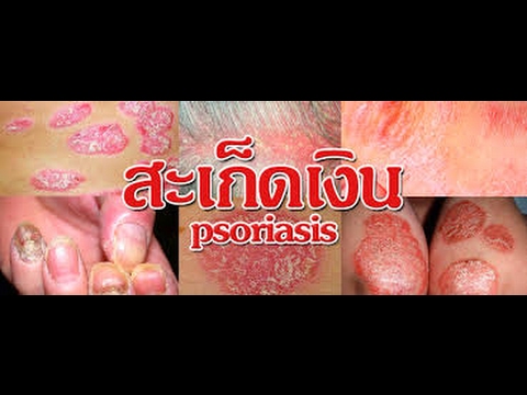 กลากครีมคัน เปลือก Glycolic ในโรคสะเก็ดเงิน
