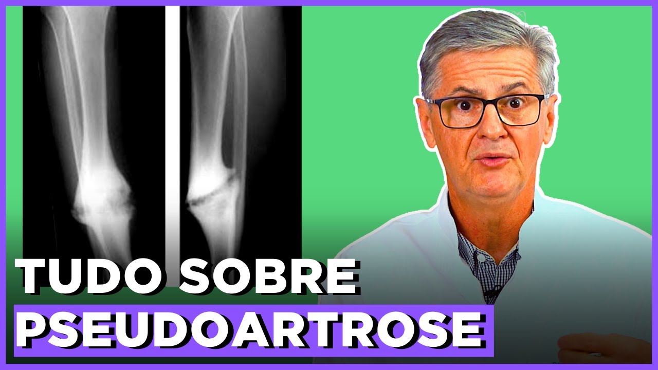 TUDO sobre PSEUDOARTROSE | Simplificando Ortopedia