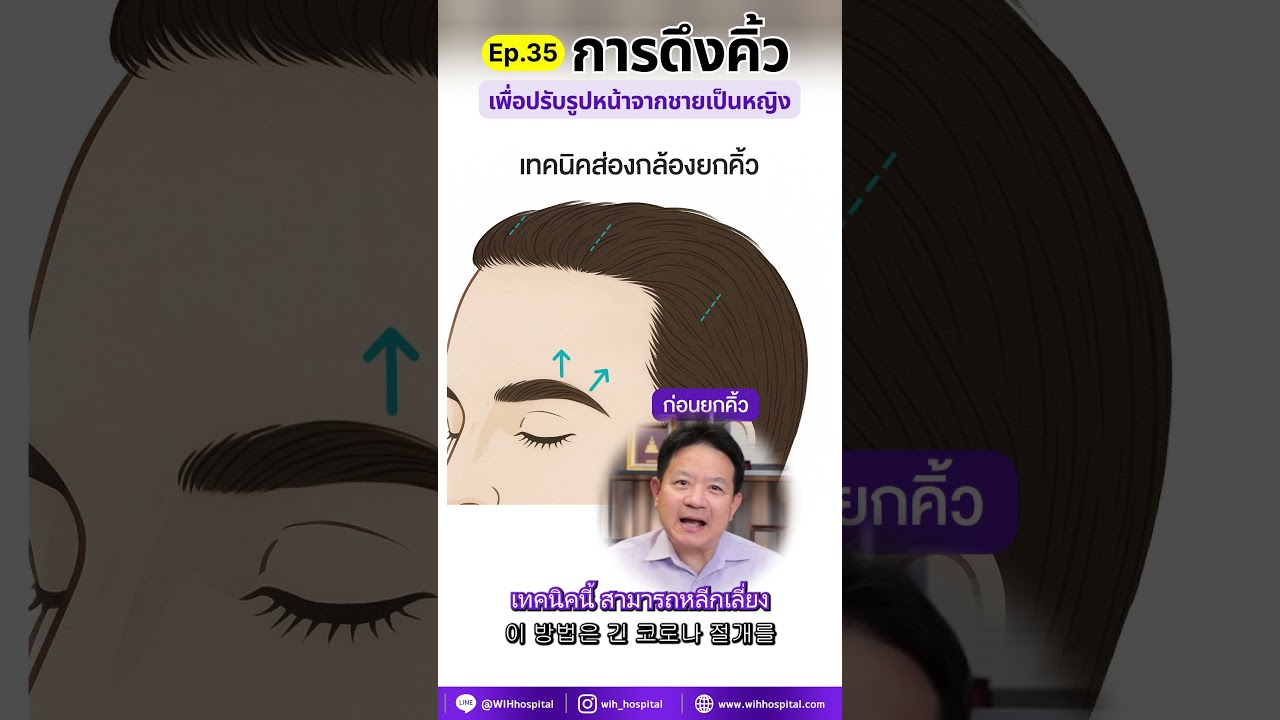 EP.35 | การดึงคิ้วในเคส transgender แตกต่างจากการดึงคิ้วทั่วไป ทั้งในเรื่องทิศทางการยกคิ้ว