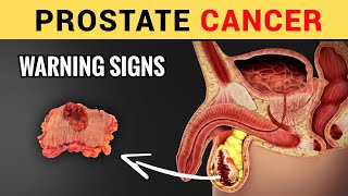 13 Early Silent Signs of Prostate Cancer (Don't Ignore) | Symptoms of Prostate Cancer