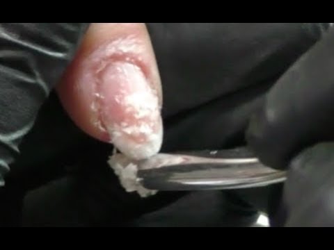 Gribok auf den Beinen bei den Kindern die Präparate Wie obmoroschenije des Fingers des Beines unter dem Nagel zu heilen