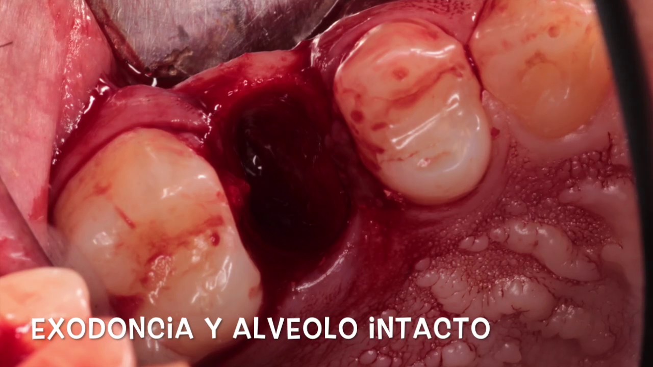 Lesión apical - Implante Frontier