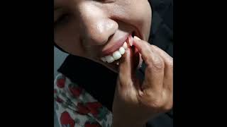 Download lagu cara pasang gigi palsu flexible #gigi #gigitiruan #flexibledenture #sorts mp3
