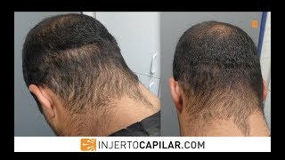 505 Grafts. HT by FUE Technique. Scar Repair.. Injertocapilar.com.1782/2016.