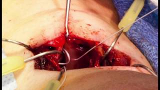 Surgically altering the male voice — Feminization Laryngoplasty