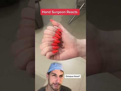 Too many fingers! #Polydactyly #Hand #Surgeon #Dr #Finger #Health #Medical