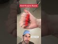 Too many fingers! #Polydactyly #Hand #Surgeon #Dr #Finger #Health #Medical