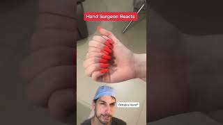 Too many fingers! #Polydactyly #Hand #Surgeon #Dr #Finger #Health #Medical