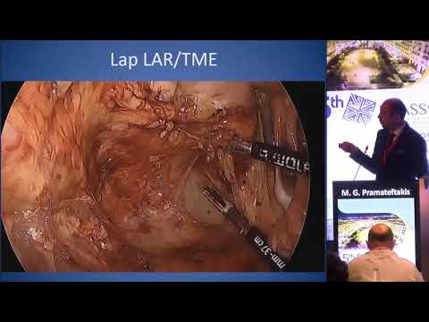 M. G. Pramateftakis - Minimally-invasive Colorectal cancer surgery