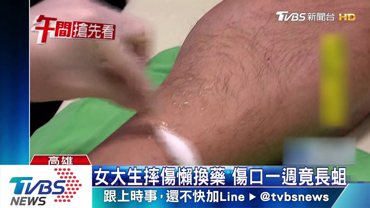 女大生懶得換藥　右腳傷口一週成「蛆窩」