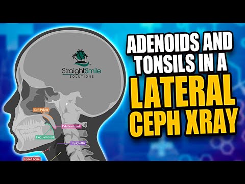 Adenoids and Tonsils in a Lateral Ceph Xray- Evaluating Airway in Phase 1 Interceptive Pediatric