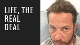 Hair Replacement Mens Hair System Review Life, The Real Deal!