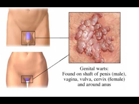 Papilloma rák kockázata - budapestfoglyai.hu