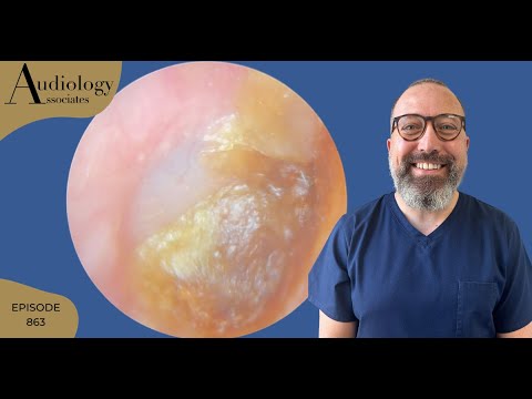 The Ultimate Earwax Removal: A Painstaking Procedure - EP863