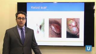 Scar and Keloid Management - Andrew Vardanian, MD | UCLAMDCHAT