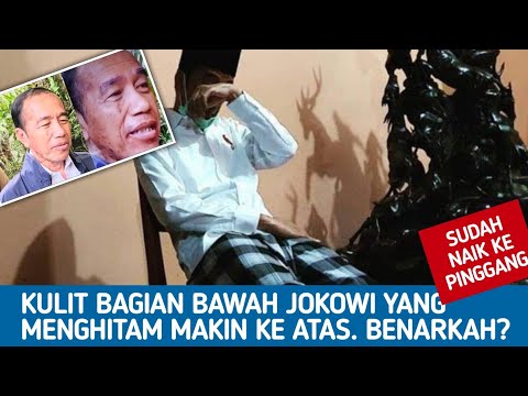 🔴LIVE‼️KULIT BAGIAN BAWAH JOKOWI YANG MENGHITAM MAKIN KE ATAS, BENARKAH?