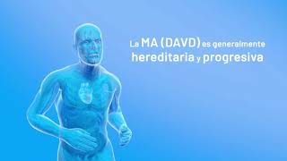 UNO DE LOS DIAGNOSTICOS DE LA MIOCARDIOPATIA ARRITMOGENICA