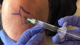 Infiltración artrosis rodilla con ácido hialurónico (Singjoint)