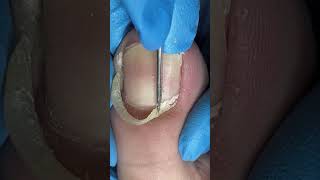 Beautiful nails require careful trimming of ingrown nails #nails #satisfying