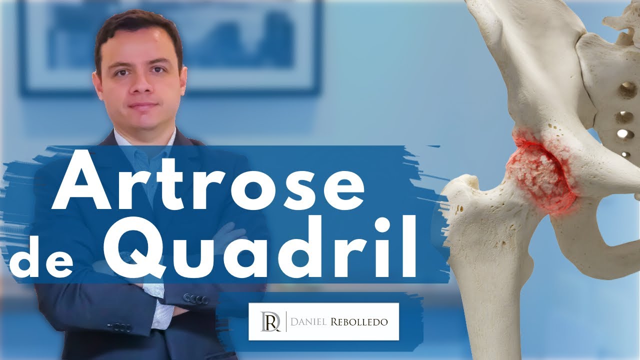 Artrose de Quadril/ Artrose de Quadril tem cura?/ Sintomas e tratamento da artrose de quadril.