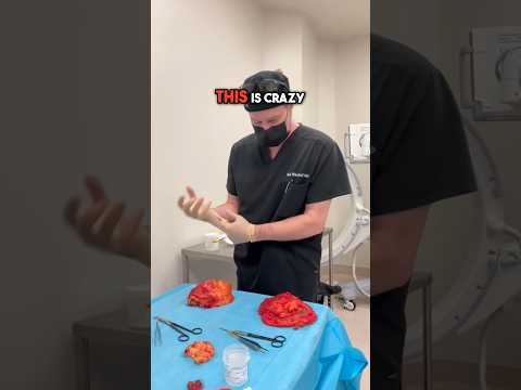 Can Ruptured Breast Implants Cause Silicone Granuloma and Chronic Pain?