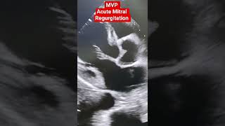 Download lagu '2D Echocardiography: Mitral Valve Prolapse & Acute Mitral Regurgitation clip' mp3 Download lagu '2D Echocardiography: Mitral Valve Prolapse & Acute Mitral Regurgitation clip' mp3