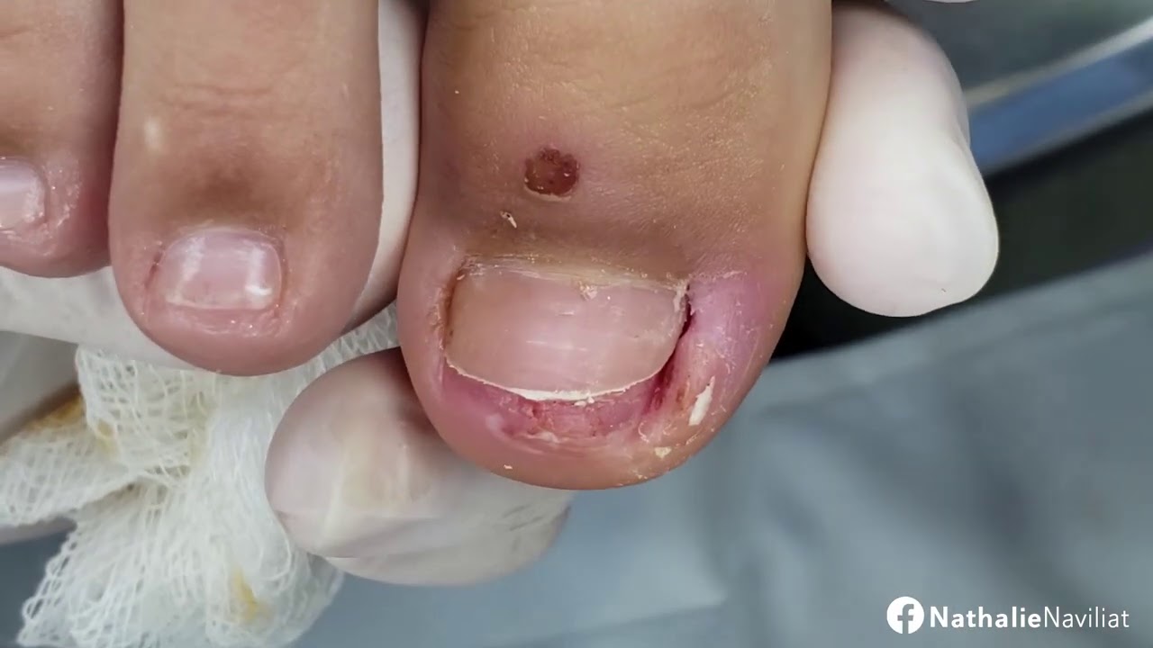 JÁ NASCEU COM A UNHA ENCRAVADA