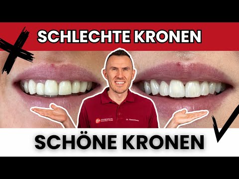 Schlechte Zahnkronen ästhetisch gestalten 2.0! Worauf du bei SCHÖNEN Frontzahn Kronen achten musst!