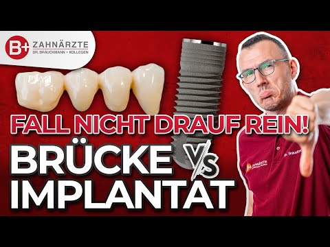 Zahnbrücke oder Implantat? VORSICHT! So entscheidest Du richtig! Zahnarzt erklärt Vor- und Nachteile