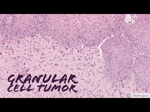 neuroendokrin rákterápia