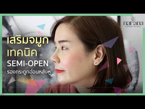 เสริมจมูกครั้งแรก เทคนิคSemi-open รองกระดูกอ่อนหลังหู ที่ Narada Clinic | คุณมิ้นท์ เสริมจมูกครั้งแรก เทคนิคSemi-open รองกระดูกอ่อนหลังหู ที่ Narada Clinic | คุณมิ้นท์