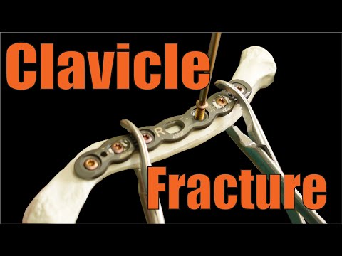 Fixing CLAVICLE FRACTURES