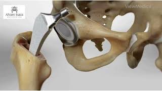 Reemplazo total de Cadera - Alvaro  Isaza Cardona