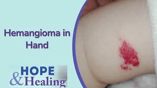 Hemangioma In The Hand | Treating Hand Pain Town Hall