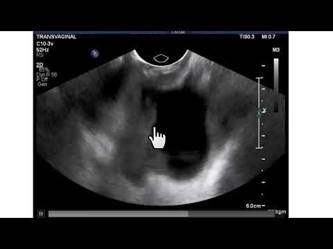 Achados da TC e da ultrassonografia transvaginal na recidiva tumoral na cúpula vaginal.