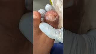 Ep_8182 Ingrown toenail removal 👣 Bragging and dying (Southern dialect) 😄 (clip from Thailand)