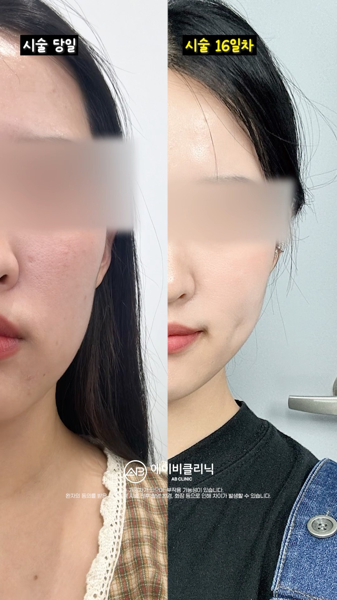 쥬베룩으로 땅콩라인 정리하는 법 🔥