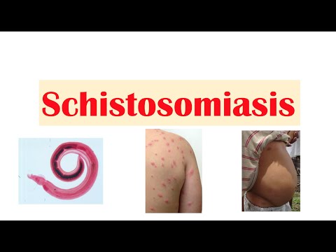 Schistosomiasis meaning