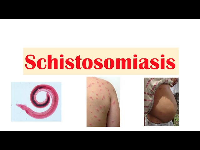 Schistosomiasis how to say,