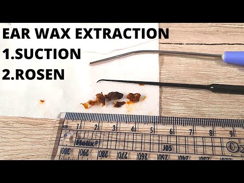 Large Ear Wax Chunks Extracted with Suction and Rosen Inserter