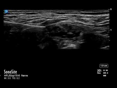 Superior trunk block - Ultrasound - awake shoulder surgery