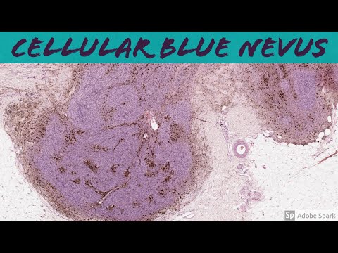 Cellular Blue Nevus: 5-Minute Pathology Pearls