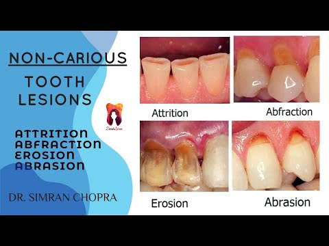 Non Carious Tooth Lesions l Attrition, Abrasion, Abfraction, Erosion l Operative Dentistry