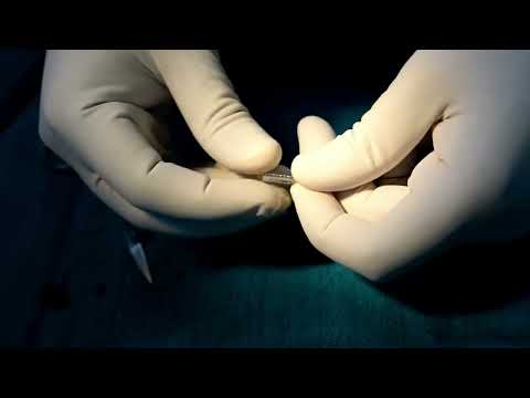 HAND MADE COVERED STENT - FOR CORONARY PERFORATION