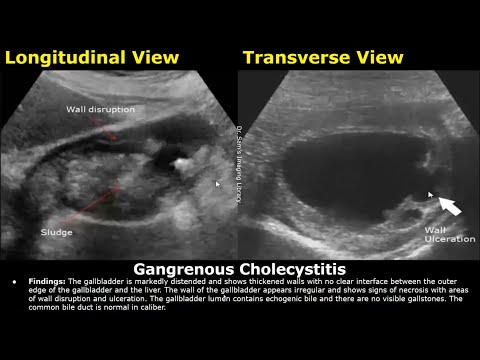 Abdominal Ultrasound Reporting | Liver, Gallbladder, Bile Duct, Pancreas, Spleen, Kidney USG Reports