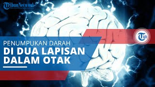 Hematoma Subdural, Kondisi ketika Darah Menumpuk di Antara Dua Lapisan di Otak