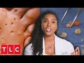 Dr. Ebonie Removes Over 200 Lesions From Patient's Feet! | My Feet Are Killing Me