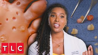 Dr. Ebonie Removes Over 200 Lesions From Patient&#39;s Feet! | My Feet Are Killing Me