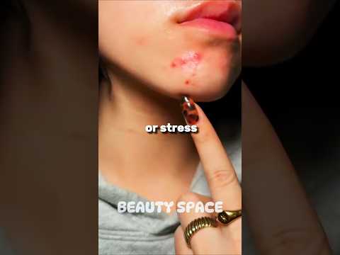 Keep breaking out in the same spot? 👀 Here’s why! #beauty #skincare #glowup